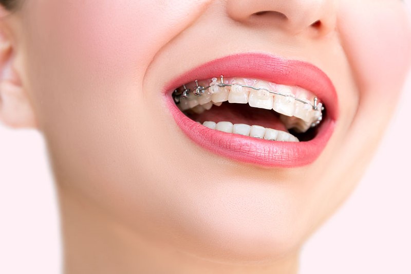 Aparaty ortodontyczne Niepołomice