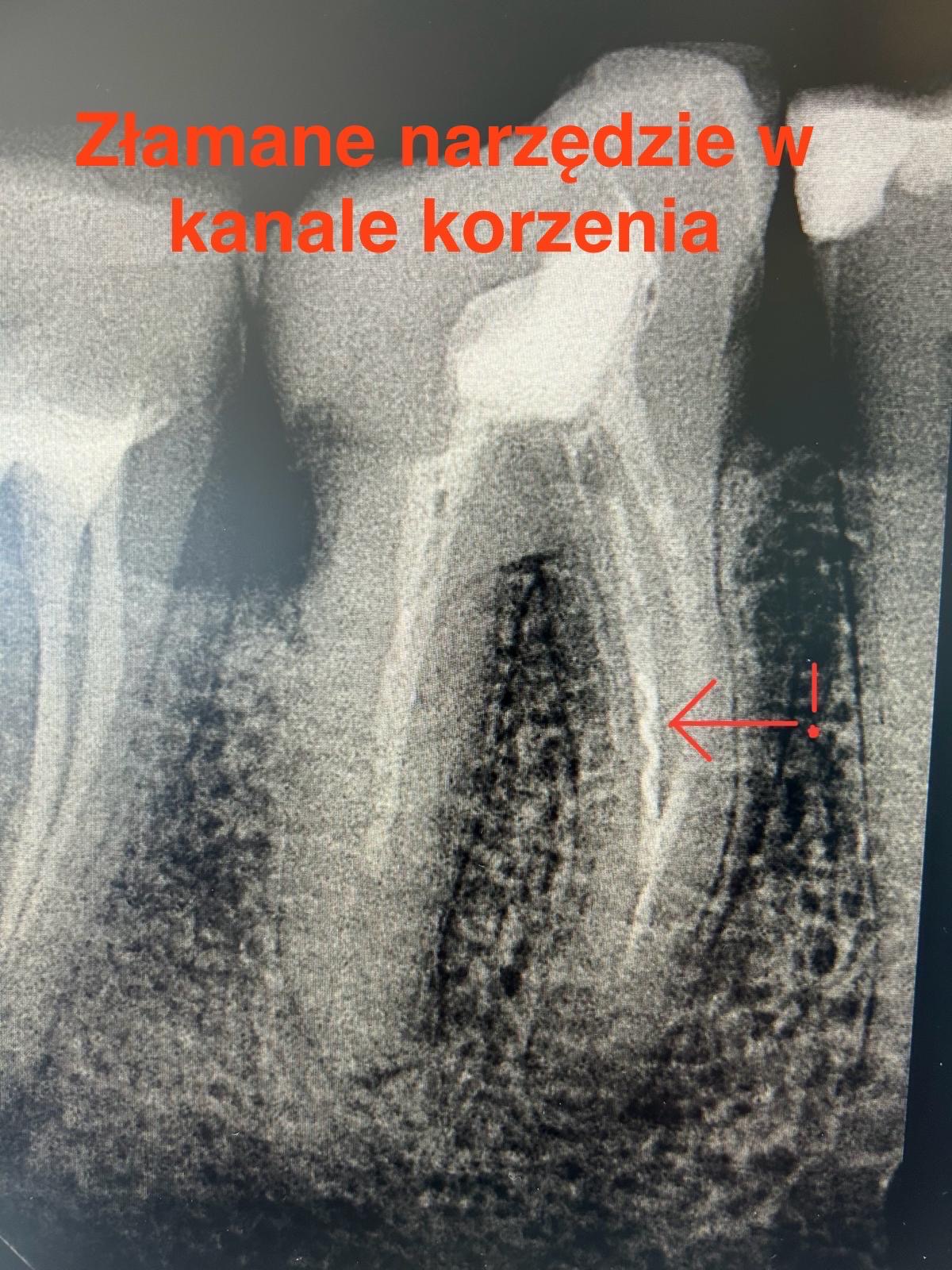 Złamane narzędzie w kanale - endodoncja Niepołomice Złamane narzędzie w kanale - endodoncja Niepołomice