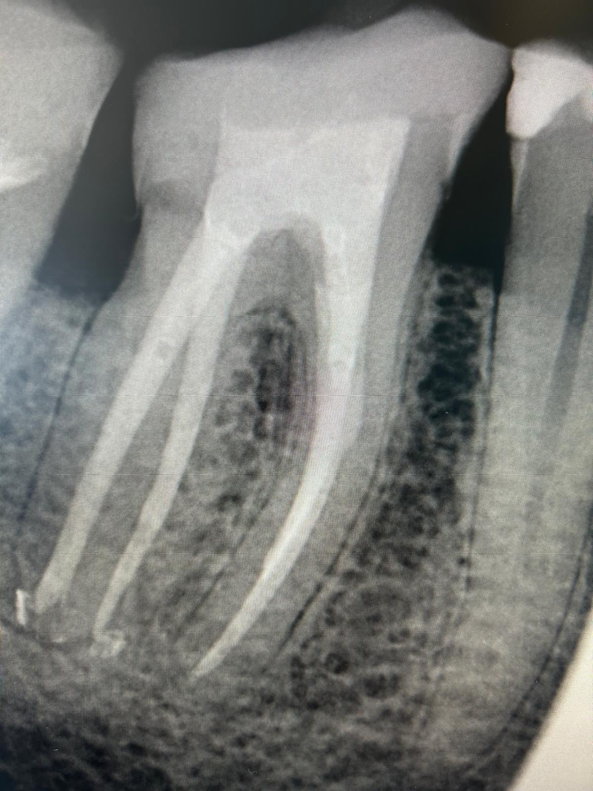 Kanał wypełniony po leczeniu endodontycznym Kanał wypełniony po leczeniu endodontycznym