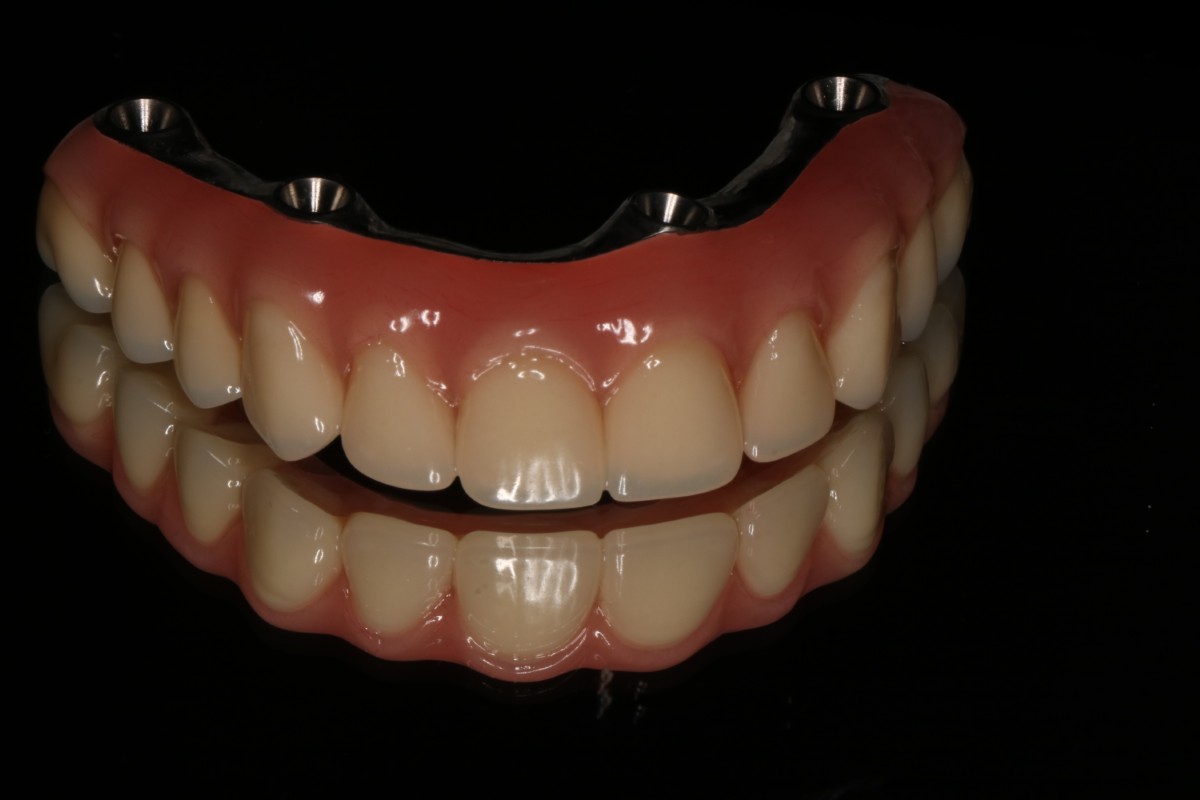 All On X - Stałe protezy na implantach – kompleksowe rozwiązania w Hestadent