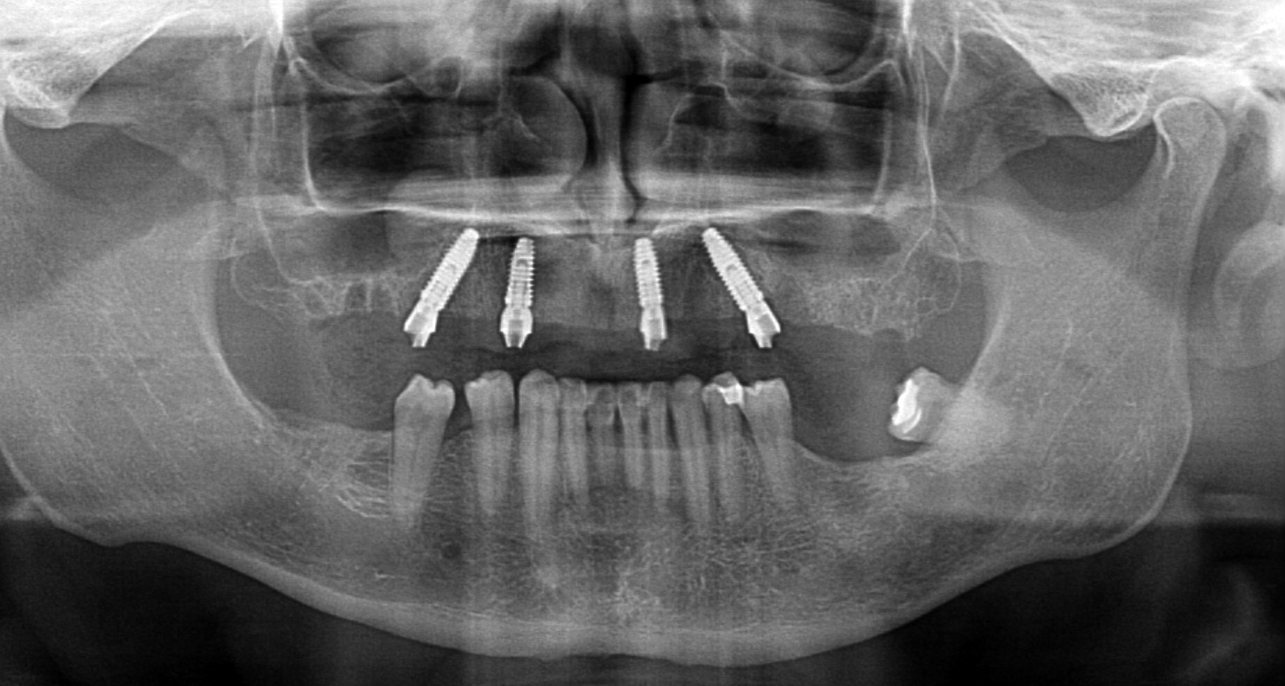 All-on-X Niepołomice