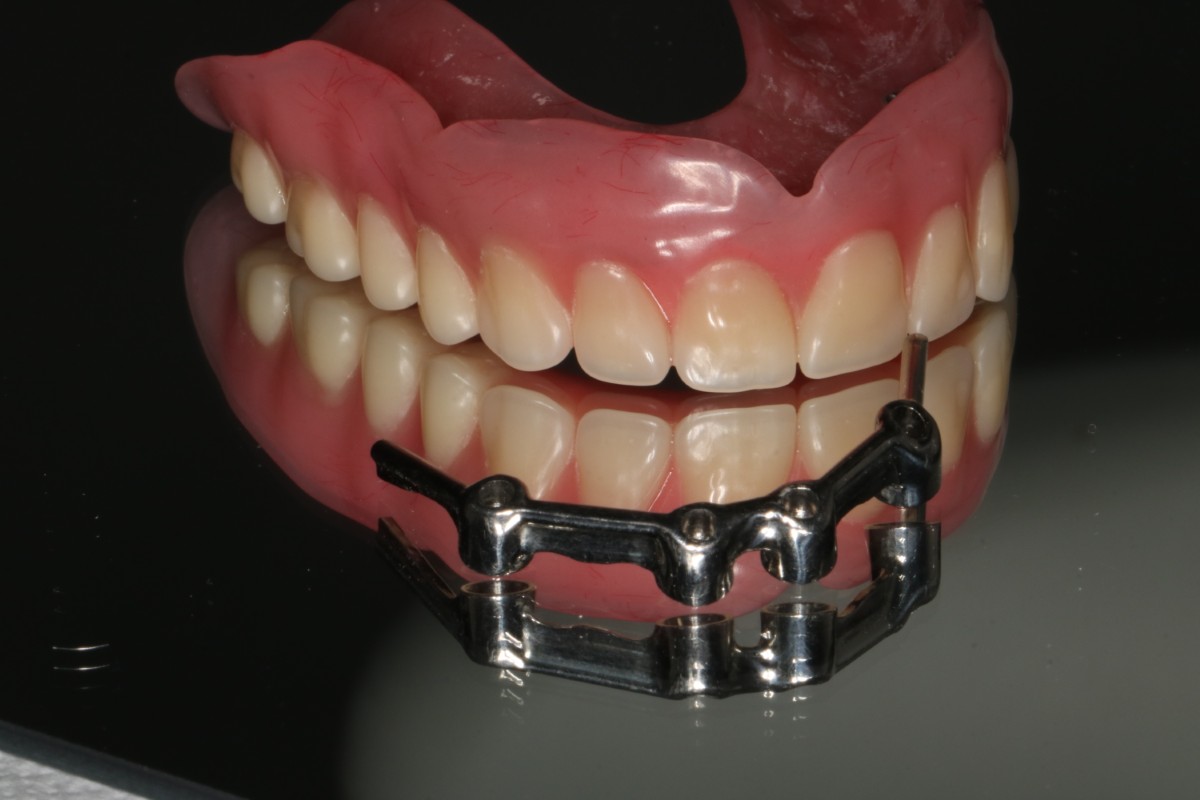 Proteza wykonana na belce retencyjnej - Stałe protezy na implantach – kompleksowe rozwiązania w Hestadent