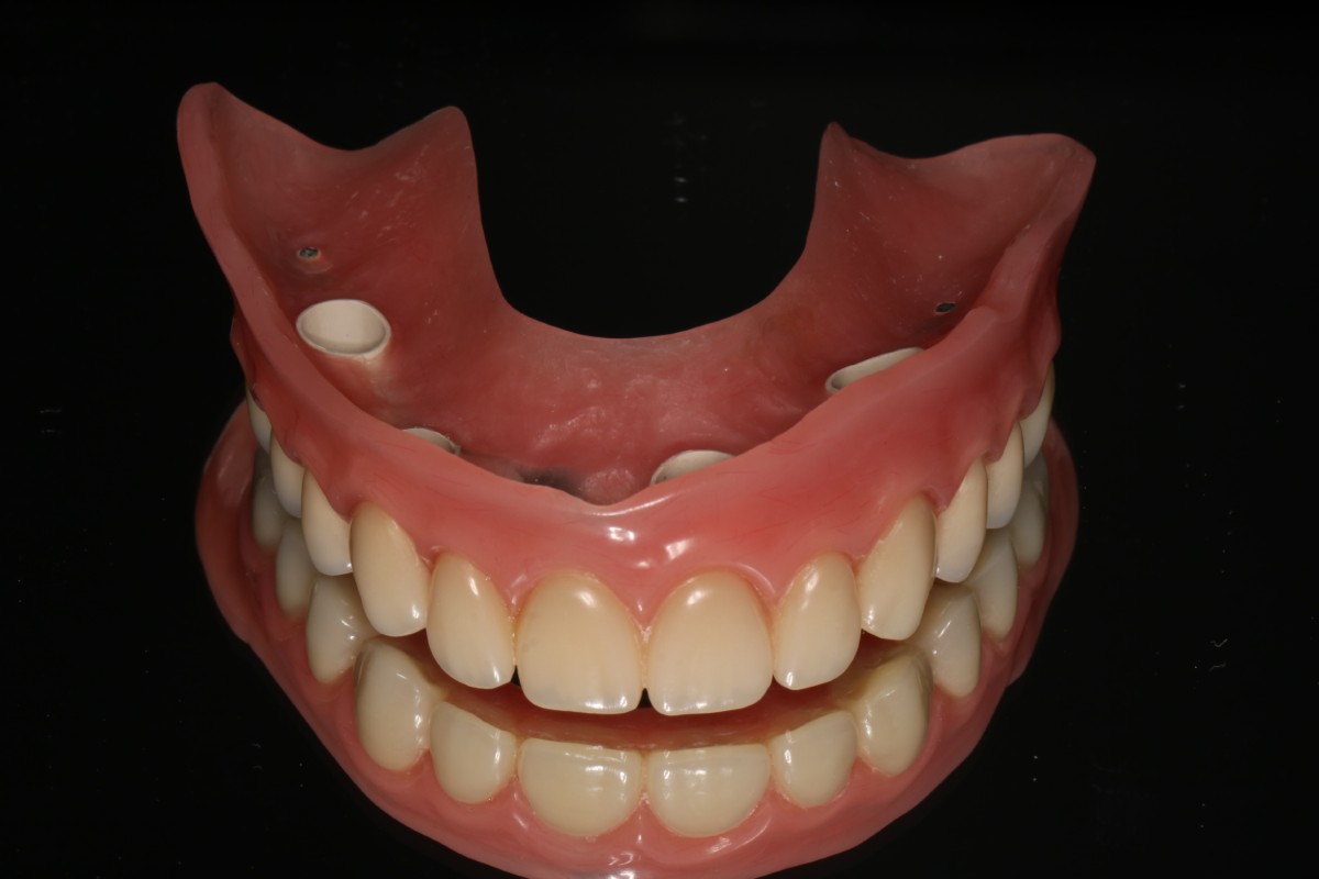 Proteza na teleskopach - Stałe protezy na implantach – kompleksowe rozwiązania w Hestadent