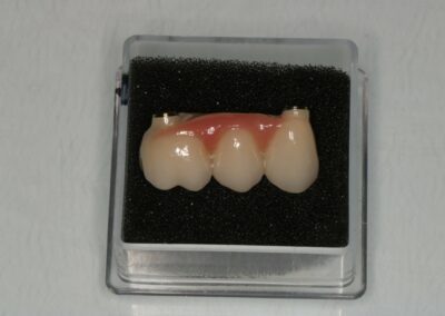 Praca protetyczna - most na implantach