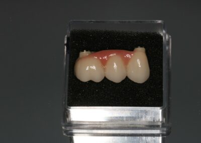 Praca protetyczna - most na implantach