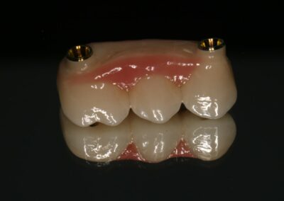 Most protetyczny oparty na implantach Niepołomice