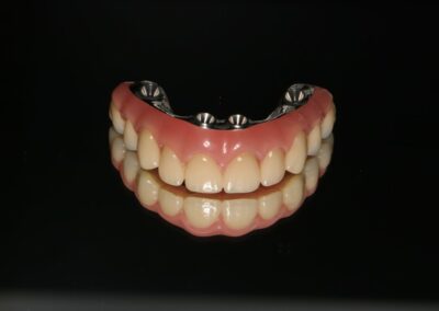 Protetyka na implantach - na belce