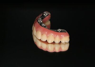 Proteza z belką na implantach Niepołomice