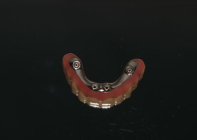 Belka na implantach Niepołomice