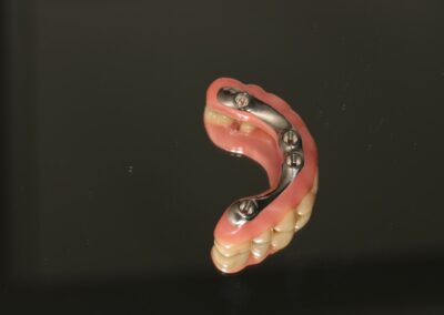 Proteza oparta na belce na implantach