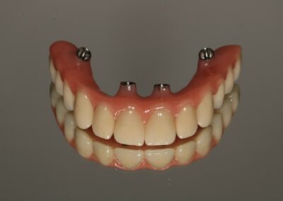 Protezy oparte na implantach Niepołomice